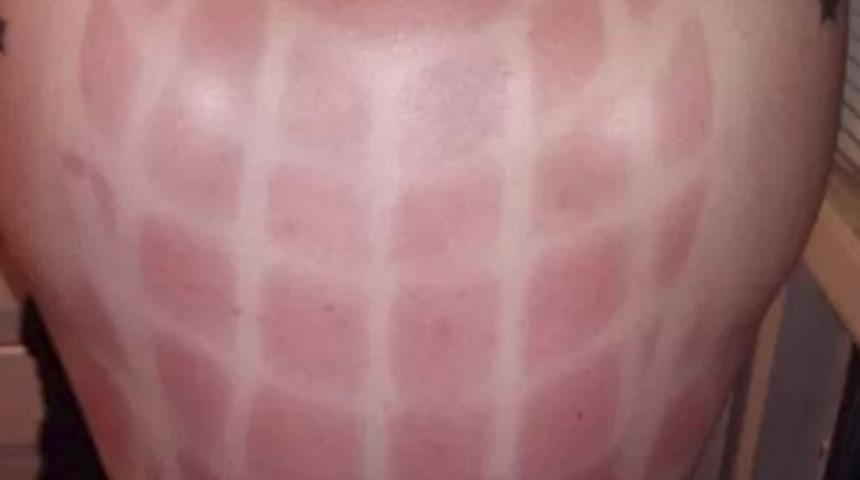 Bir yaz klasiği: Amele yanığı sanatı!