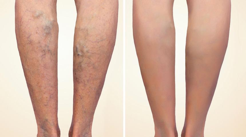 Uzmanlar uyarıyor varis belirtilerini hafife almayın! Varis tedavisi sandığınızdan daha önemli!