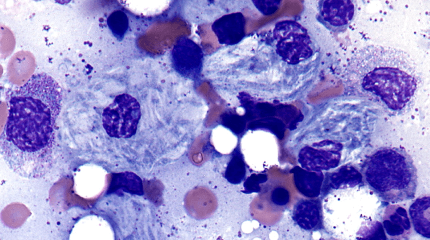 Gaucher hastalığı nedir? Gaucher hastalığı nasıl teşhis edilir? Gaucher hastalığı neden olur?Gaucher hastalığı tedavisi nasıldır?