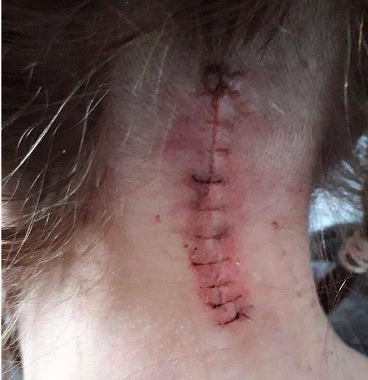 Baş ağrısı deyip geçmeyin! Migreni var sanıyordu beyinciği sarktı! G2