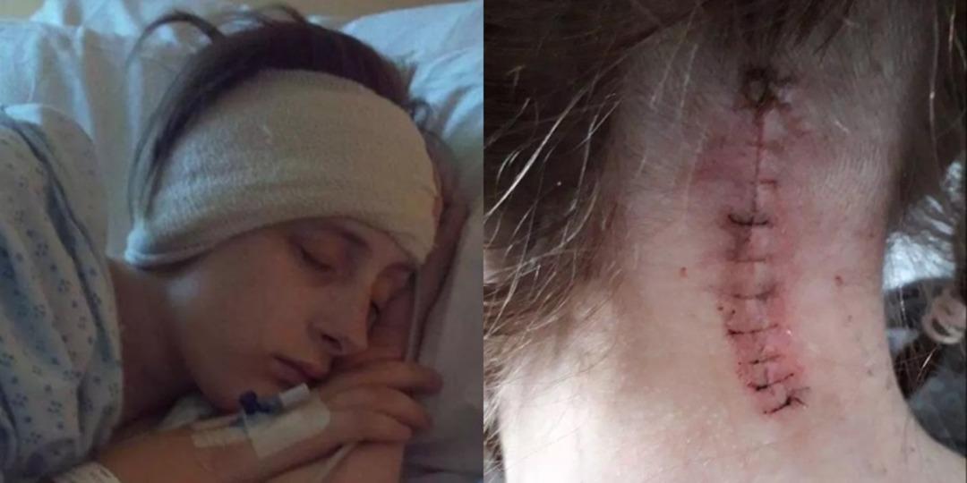 Baş ağrısı deyip ge&ccedil;meyin! Migreni var sanıyordu beyinciği sarktı!