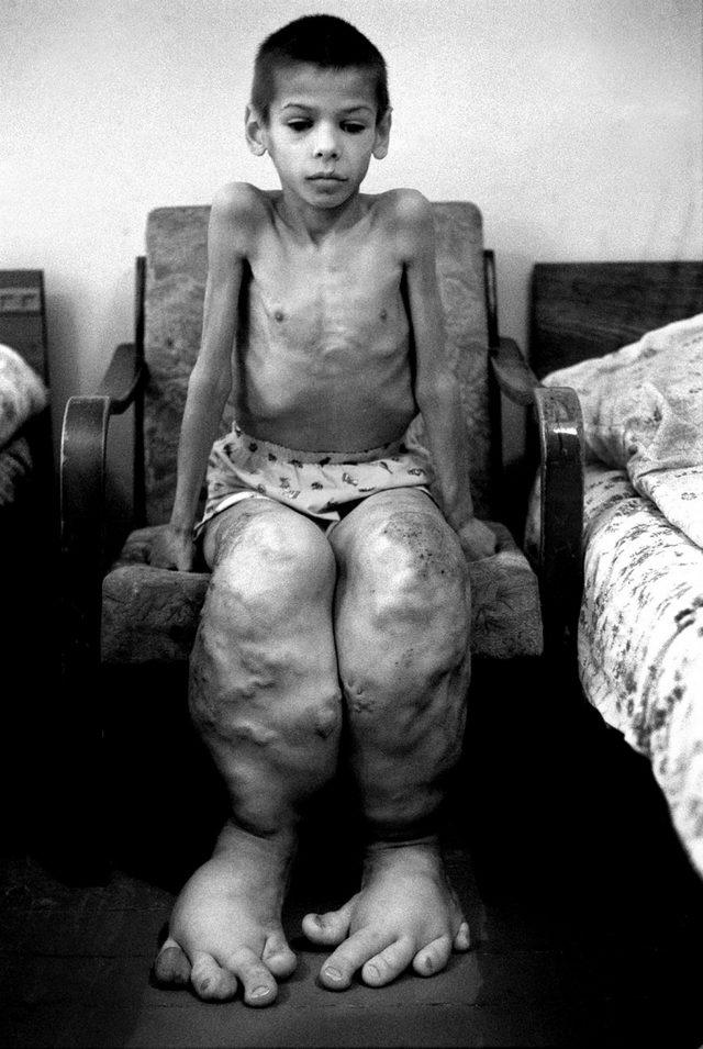 1986 Yılında Nükleer Patlama Sonucu Çocukluklarından Olanların 16 Fotoğraf  Karesi! - Mynet trend