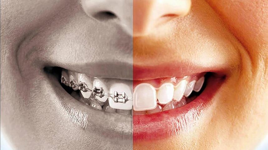  Invisalign tedavisi mi yoksa diş teli mi?