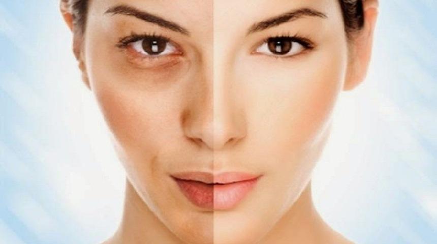 G&ouml;z Altı Torbalarınızı Yok Etmenin 7 Doğal Yolu