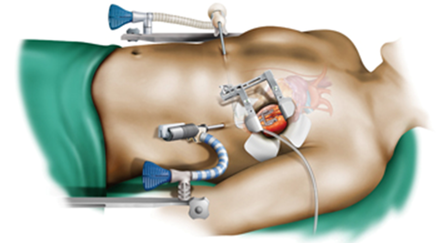 Minimal invaziv koroner bypass cerrahisi nedir?