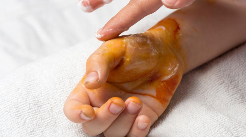 Yanığa ne iyi gelir? Yanığa iyi gelen besinler ve evde doğal tedavi yöntemleri