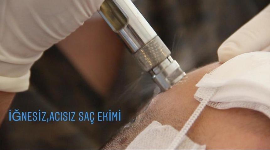 Yeni trend ağrısız, acısız, iğnesiz sa&ccedil; ekimi teknolojisi