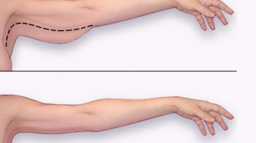 Kol germe ameliyatı nedir? Kol germe ameliyatı olanlar nasıl bir süreçten geçiyor?