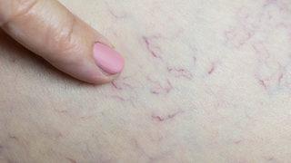 Kadınlarda daha çok görülüyor! İşte varise yol açan 10 faktör