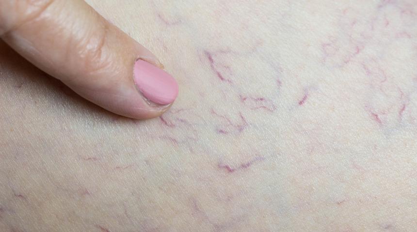 Kadınlarda daha çok görülüyor! İşte varise yol açan 10 faktör