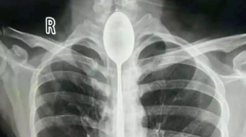 Boğazından 20 santimlik kaşık &ccedil;ıkarıldı