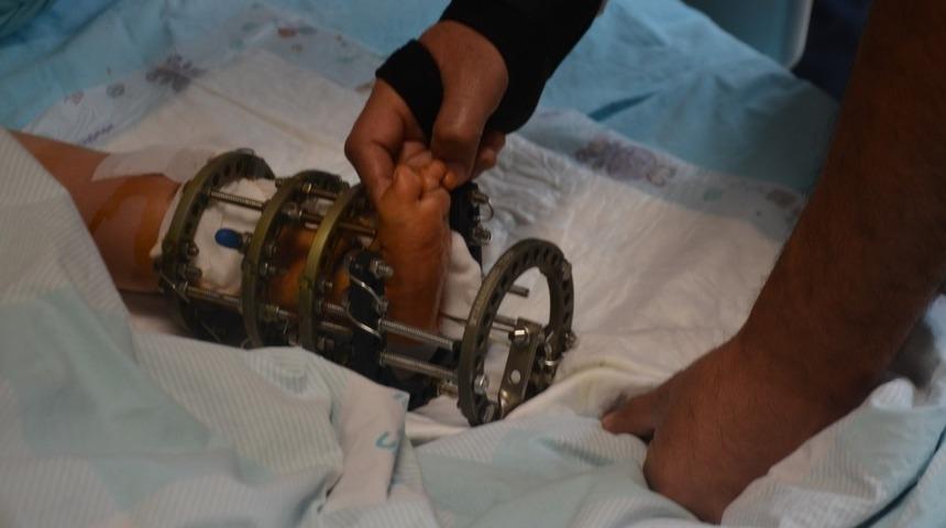 Küçük çocuğun ayak bileğindeki eğrilik ameliyatla düzeltildi