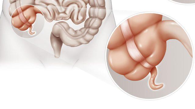 'Parkinson bağırsaklarda başlıyor, apandisi alınanların hastalığa yakalanma riski daha az'