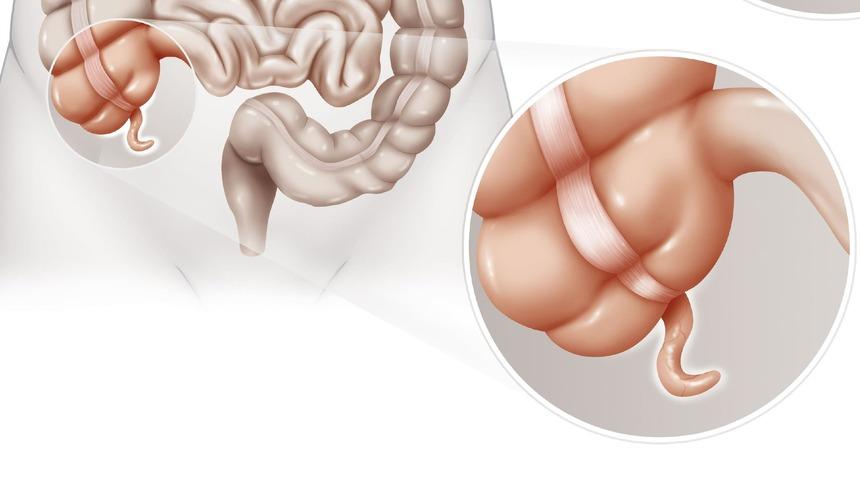 'Parkinson bağırsaklarda başlıyor, apandisi alınanların hastalığa yakalanma riski daha az'