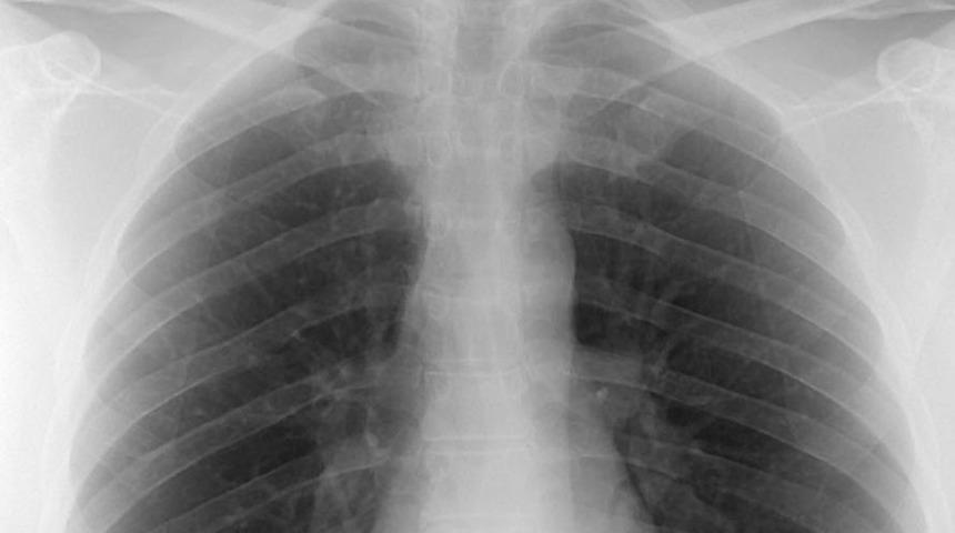 Akciğer tomografisi için korkutan uyarı: Faciaya dönüşecek