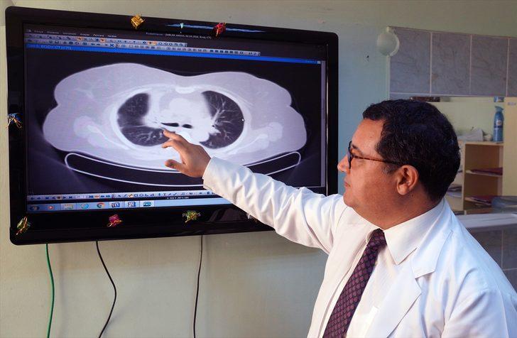 Kanserli hücre sandılar bakın akciğerinden ne çıktı  G3