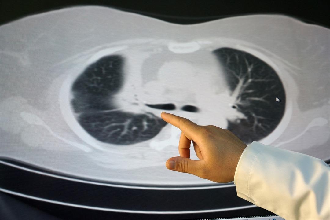 Kanserli h&uuml;cre sandılar bakın akciğerinden ne &ccedil;ıktı 