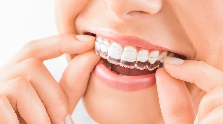 Lingual teknik (içten tel tekniği) ile invisalign tedavilerinin 5 farkı